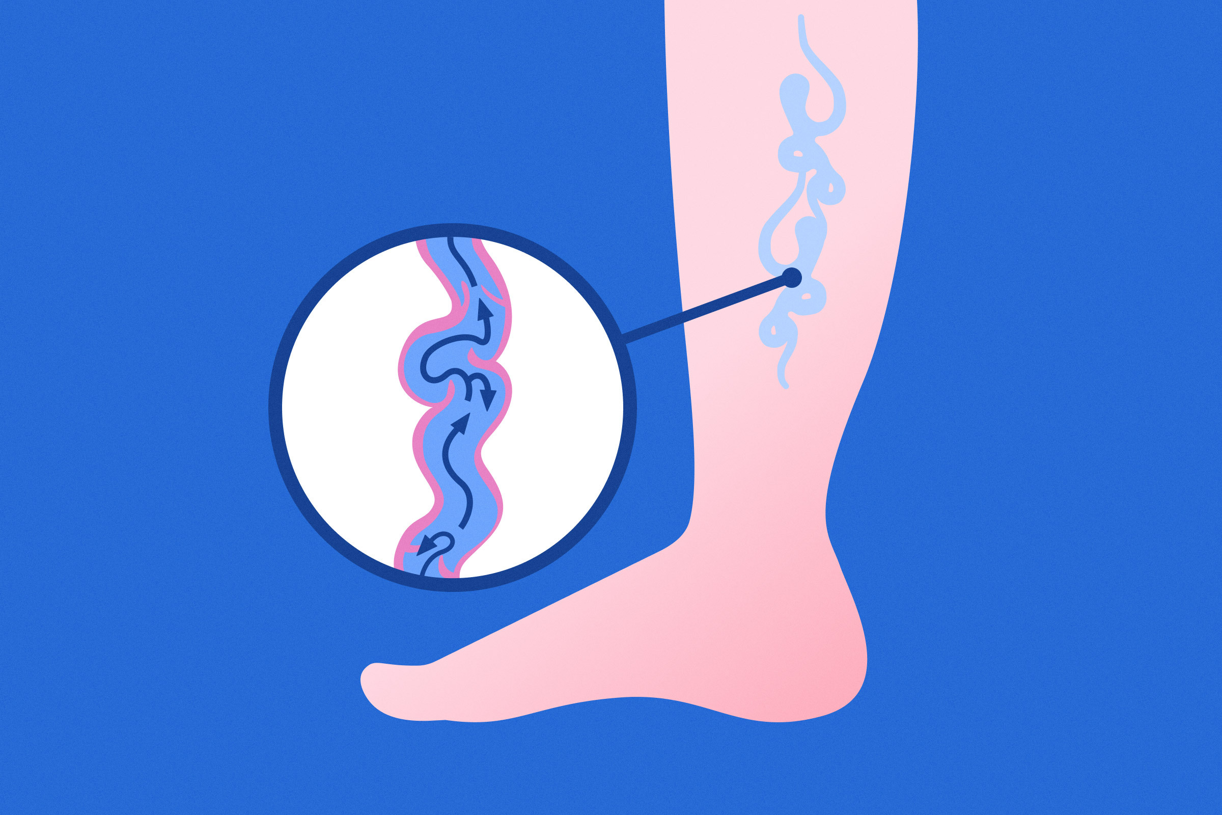 하지정맥류를 묘사하는 이미지