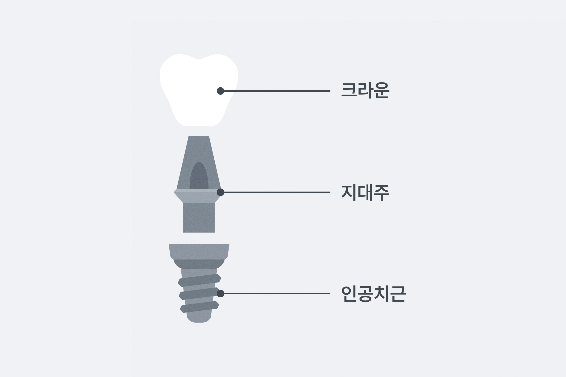 임플란트 구조를 설명한다